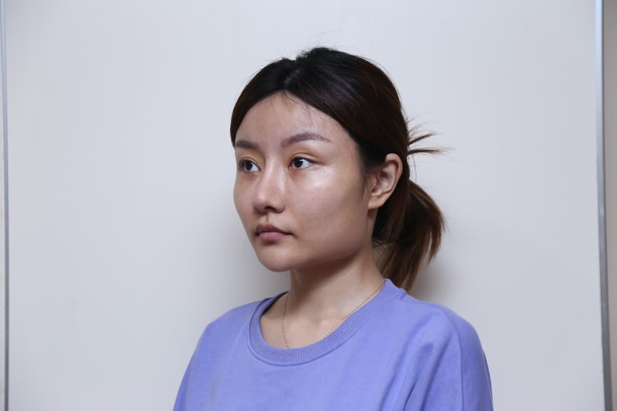 二十多年的大脸盘子终于摆脱了,从此人生轨迹都发生了改变,做下颌骨真