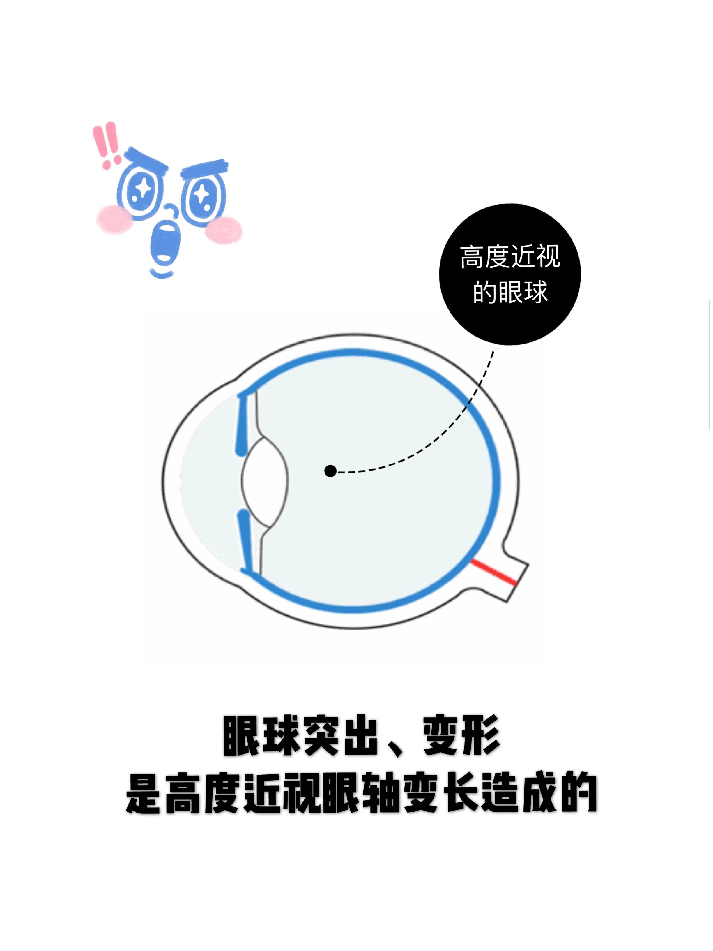 "金鱼眼"做近视手术,能改善眼睛变形吗