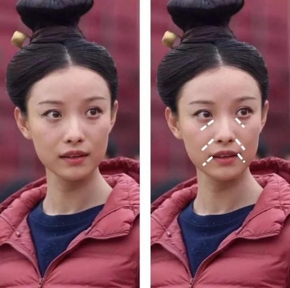 图中的 泪沟,法令纹,木偶纹,俗称面部"三八线",这几点都是破坏面部美