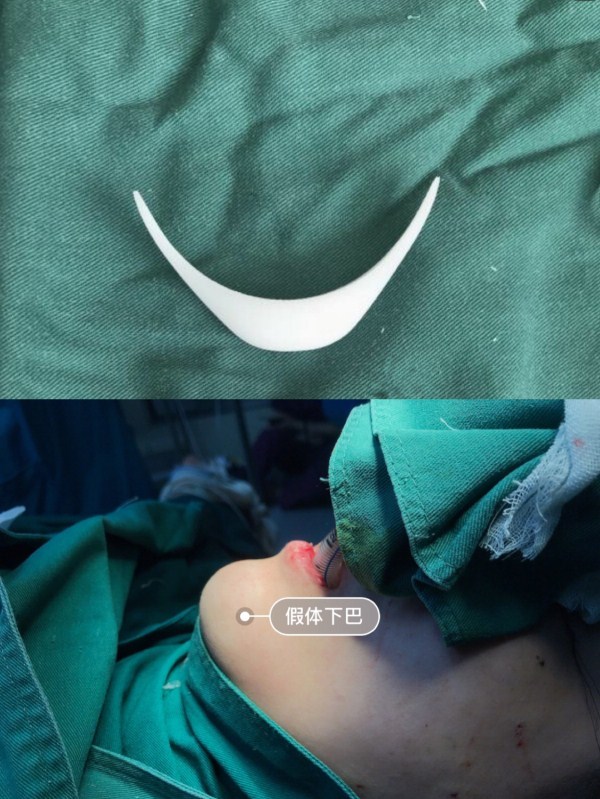 颏v成型术: 颏成形术包括矫正颌部发育过度,发育不良以及颏部偏斜等