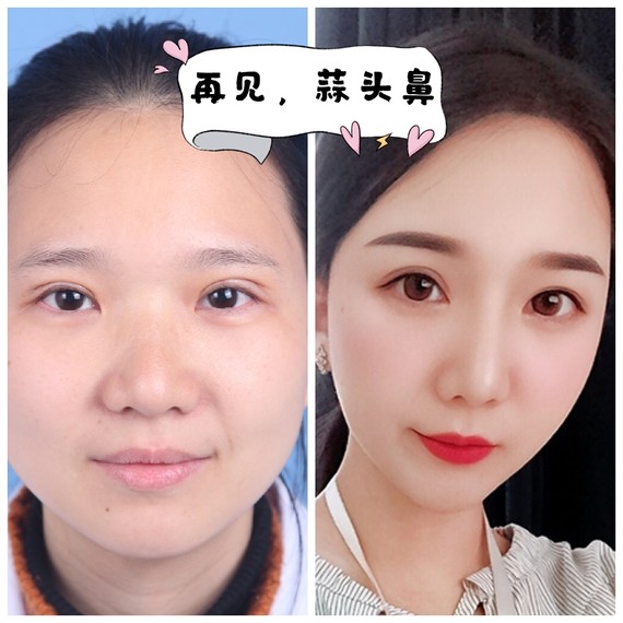 93想摆脱蒜头鼻,只做假体隆鼻可以吗?91大鼻头是