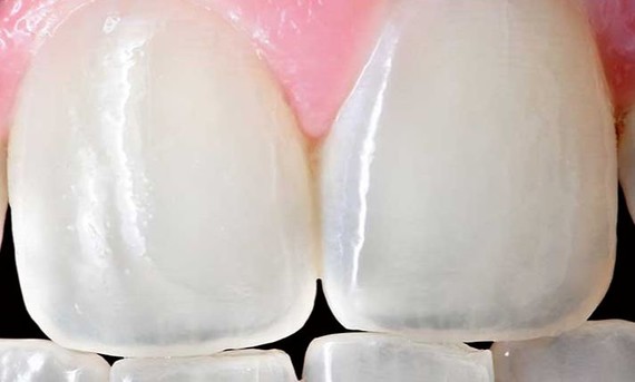很有可能是因为牙釉质钙化程度太高了,更透明一些,使得牙本质这层的