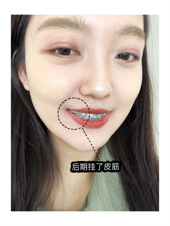 牙齿矫正