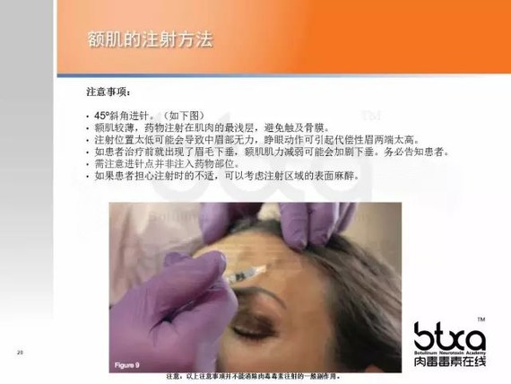 斜方肌疼痛点加一点注射每侧5 u 看得不过瘾的,可以戳下列视频