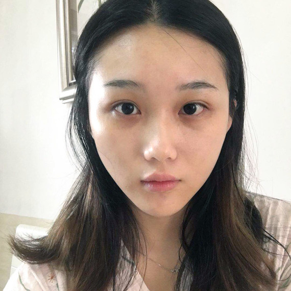 不同的去眼袋术,恢复时间是不一样的.