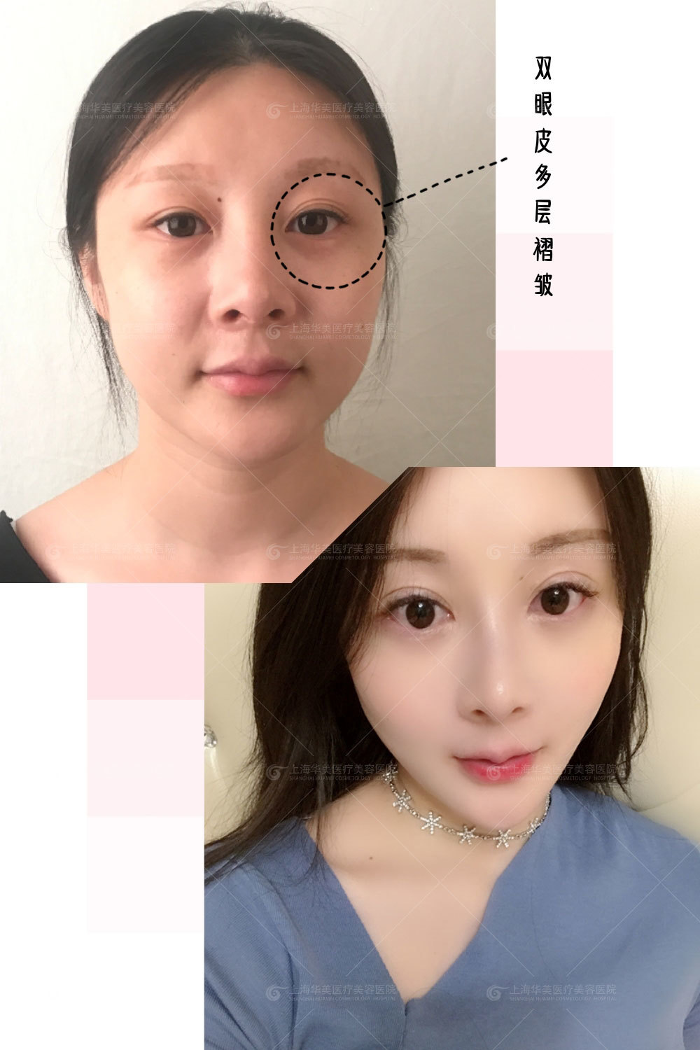 实例1(p2): 双眼皮多层褶皱 表现:一般表现为三眼皮