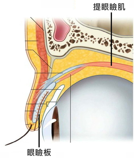 提肌手术:若眼皮是卷帘门,提眼睑肌就是链条,把眼睑板拉起,让