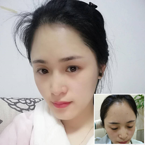 发际线种植成功后还会后移吗?看看她术后6个月的效果