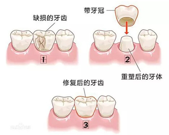 首先我们要先来明确牙冠和贴面分别是什么?分别适用于什么情况?