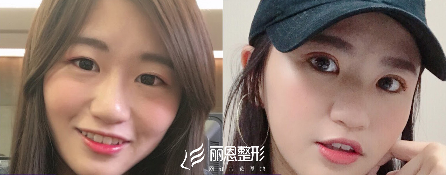 你好,我的肿眼泡比较严重,想要做一个_新氧-专业医美服务平台
