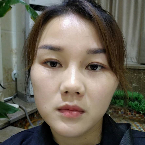 术前分析: 妹子术前正面看短鼻,山根偏低,鼻小柱内缩