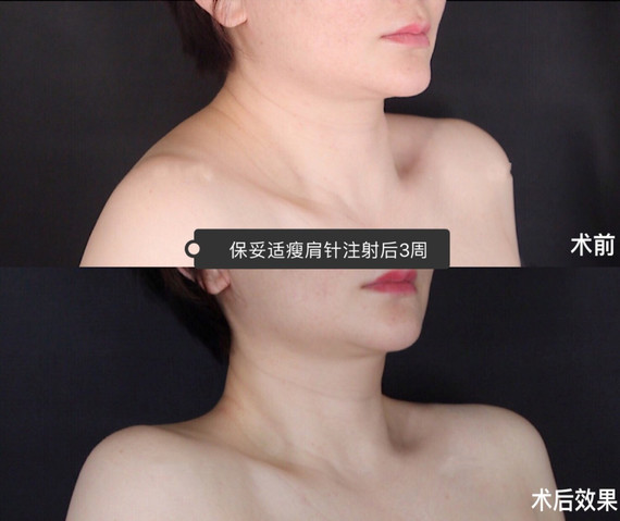 肉毒素注射"斜方肌 颈阔肌"全方位打造天鹅颈