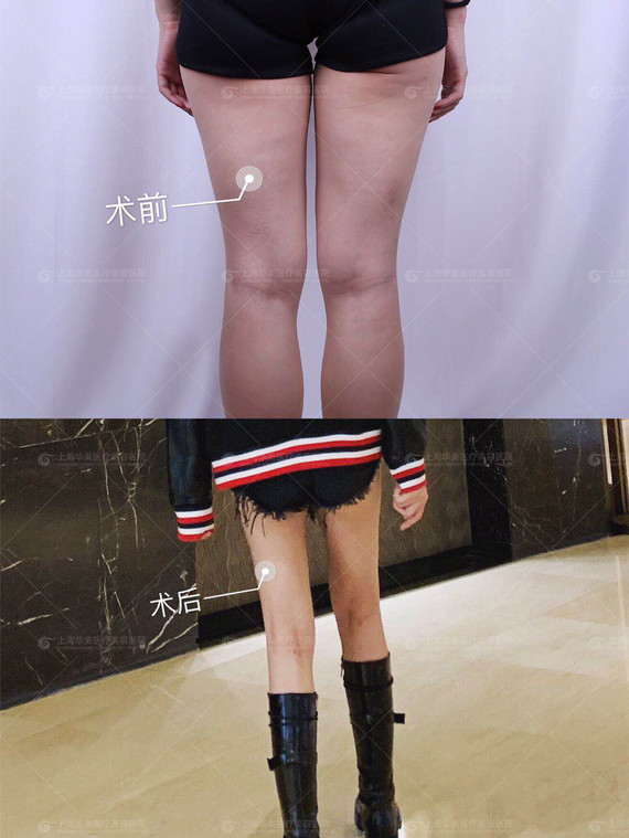 大腿吸脂
