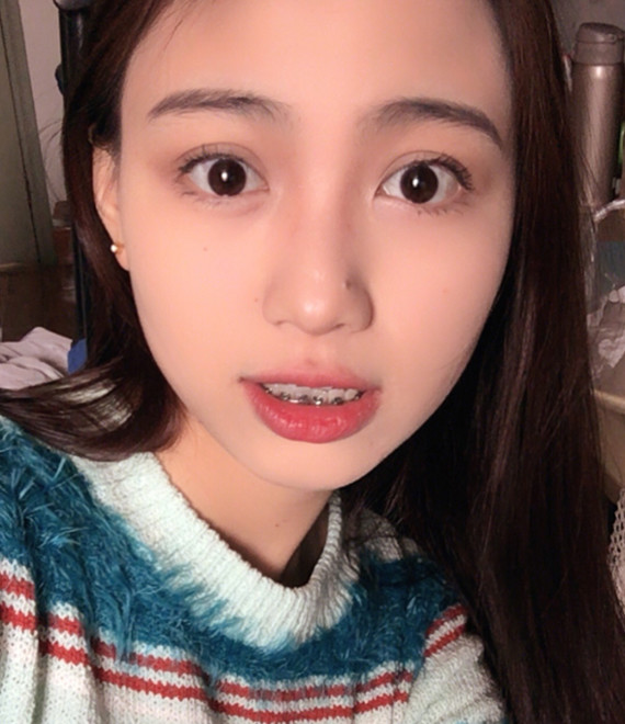 美年龄失去逆袭,a年龄笑~少女:16岁时女生双臂矫正图片