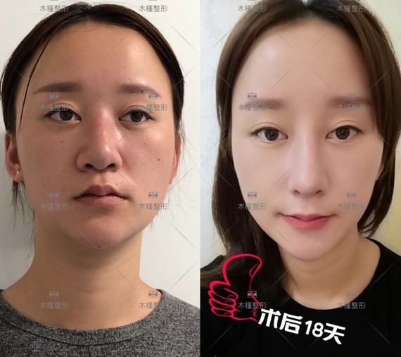 手术缩鼻翼