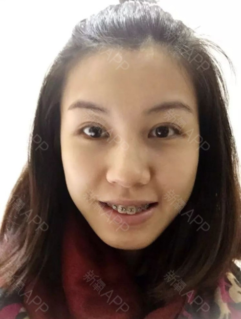 丑一时,牙齿矫正好美一辈子,人生是我的,还是听取自己内心吧,不想以后