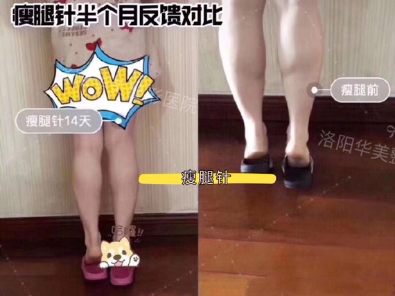 【洛阳华美可以医院-小腿针】瘦腿是你减喝整形v医院多白水吗图片