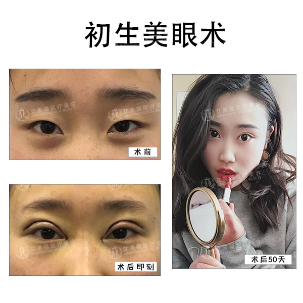单纯的小眼症只需同时进行眼角开大术即可.