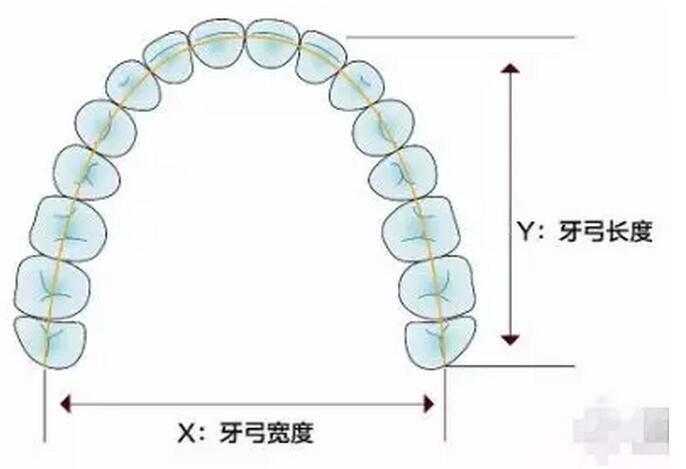 牙弓宽会导致脸变大么?