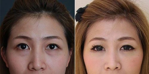 玻尿酸 泪沟深得谁看着不难受