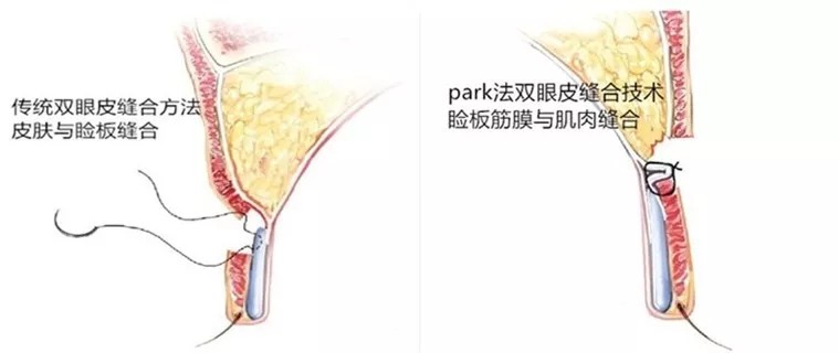 超park法重睑术原理在于保护了上睑大部分血管,肌肉组织,使上睑内外侧