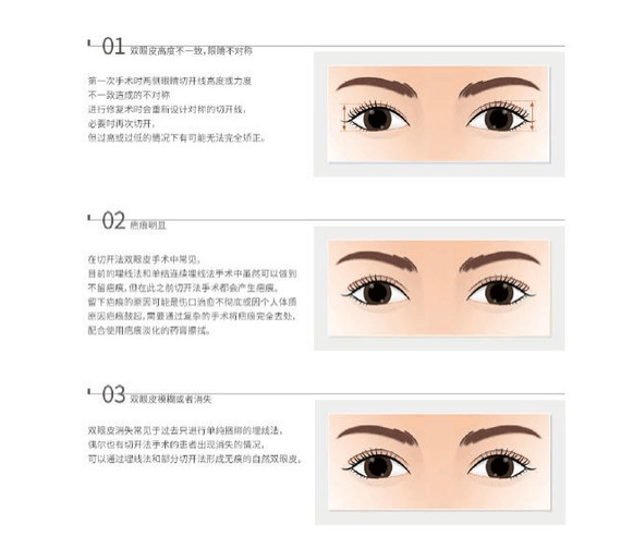双眼皮割丑了要怎么救?