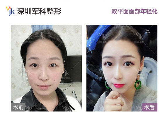 面部年轻化——手术治疗方法 除皱变年轻