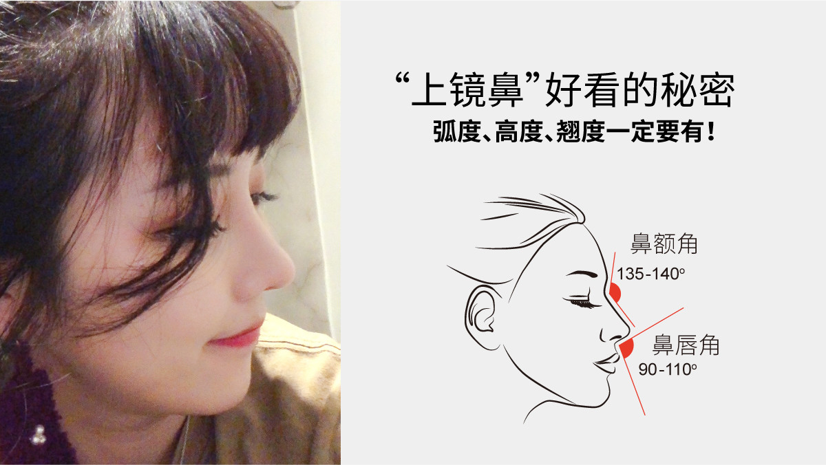 这个姑娘的中面部是比较偏长的,我给她做的鼻子,你可以先参考看下