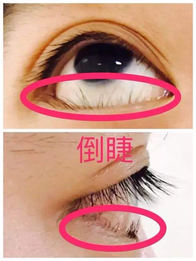 倒睫是怎么回事,能治好吗?