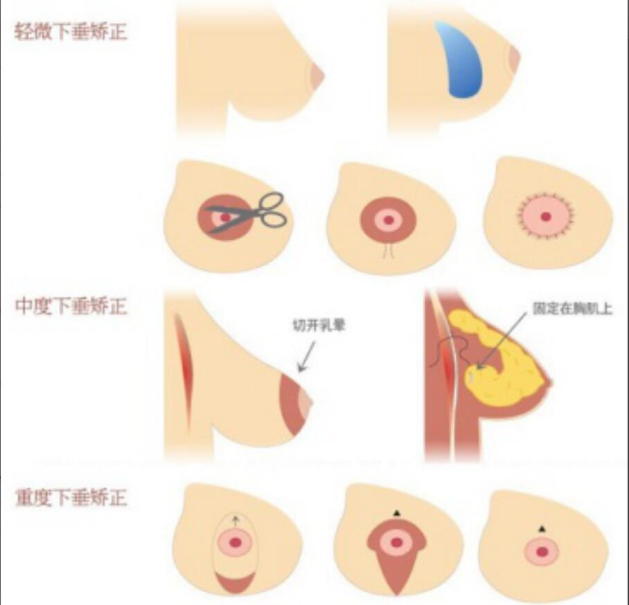 生完孩子后乳房下垂怎么整形,乳房下垂矫正效果好吗,自然吗?