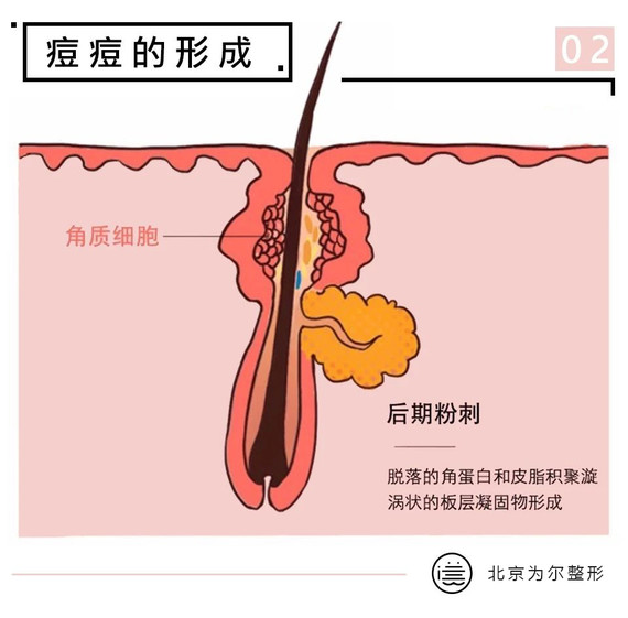 当角质细胞,皮脂慢慢堆积,形成一大团黏糊糊的脂栓,就是粉刺了.