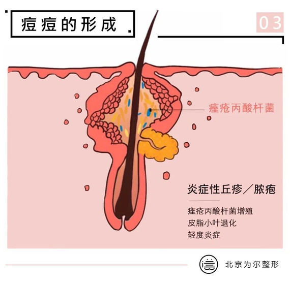 当角质细胞,皮脂慢慢堆积,形成一大团黏糊糊的脂栓,就是粉刺了