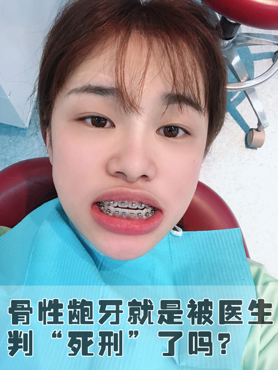简单给大家说一下骨性和牙性龅牙的区别吧 ①牙性龅牙 单纯的牙齿前