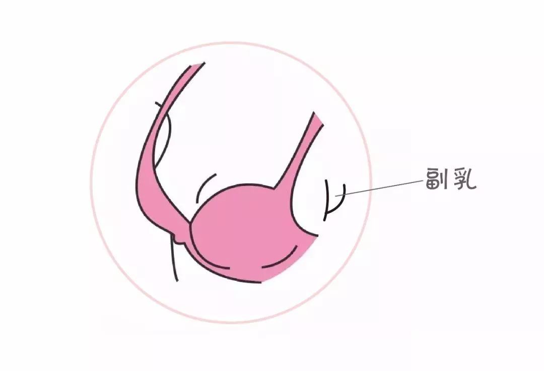 有副乳怎么办呢