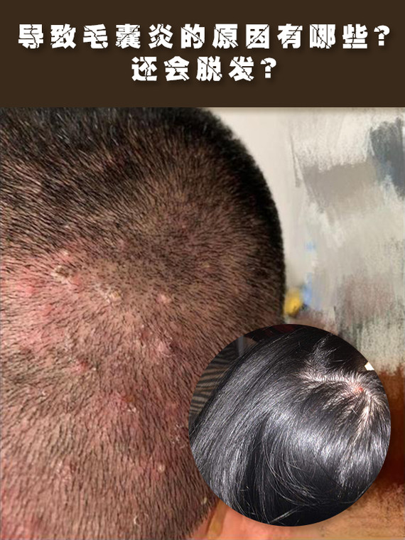 【植发趣识】诱发毛囊炎的原因是啥?还会导致脱发嘛?