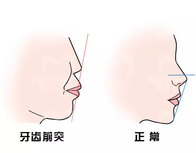 鼻基底凹同时还嘴突先做正畸还是鼻基底