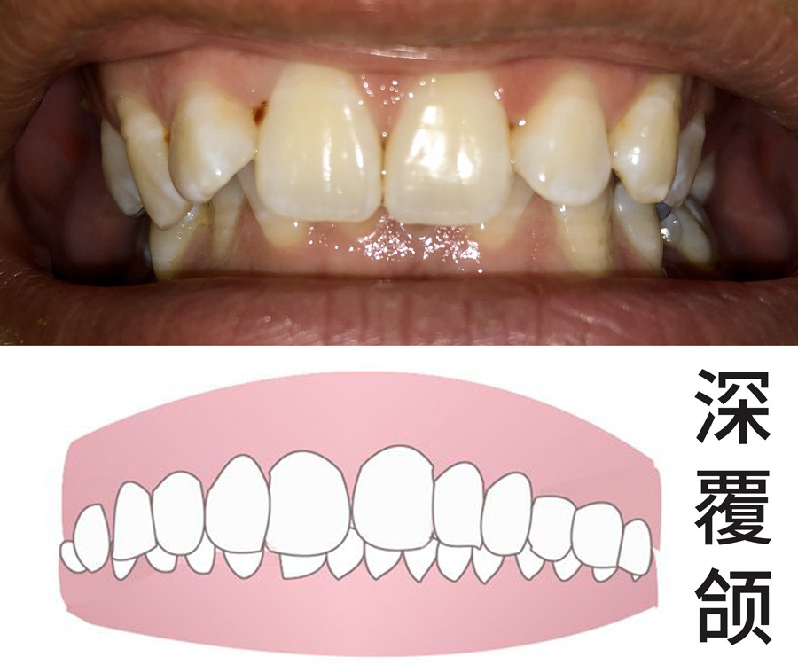 深覆颌不仅影响正常的咀嚼,加重牙齿的异常磨损,也是影响脸型和嘴型