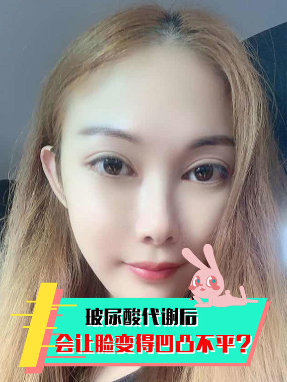 玻尿酸代谢后会让脸变得凹凸不平?