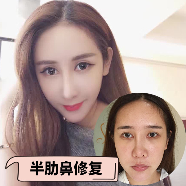 隆鼻假体取出以后,鼻子会变形吗?