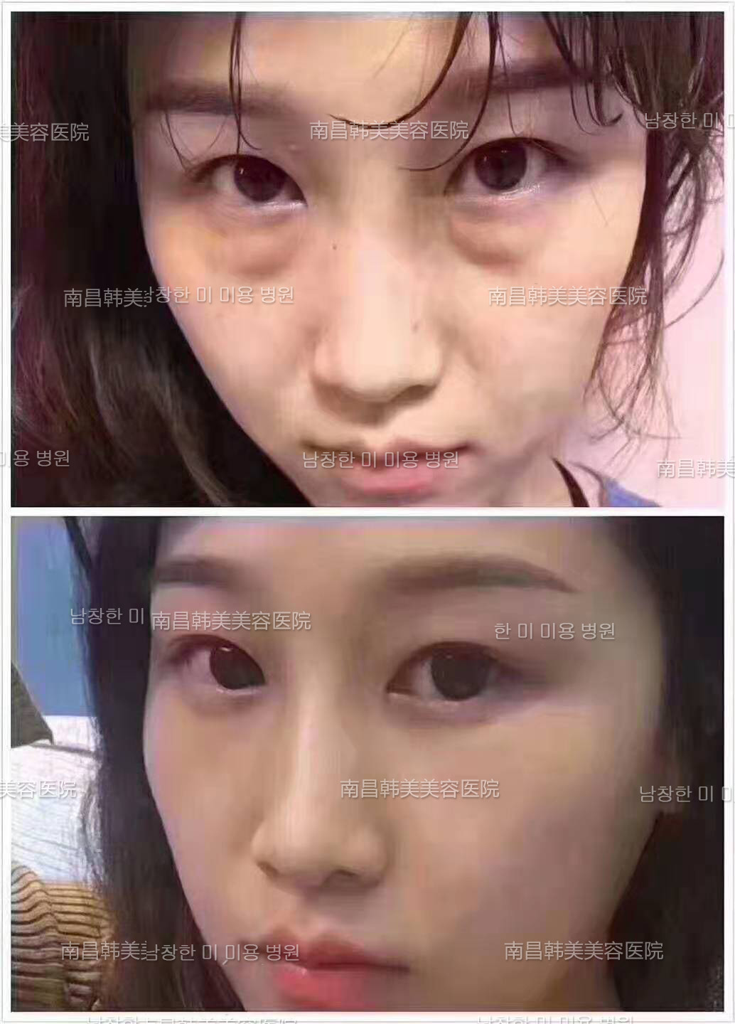 天生眼袋比较重要怎么消除啊做手术切除眼袋好吗