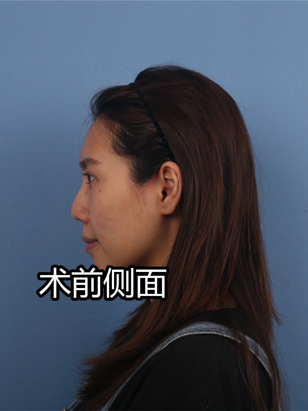 隆鼻不是做得又高又翘就是最好看,有的妹子就喜欢做成自然风的鼻子,让