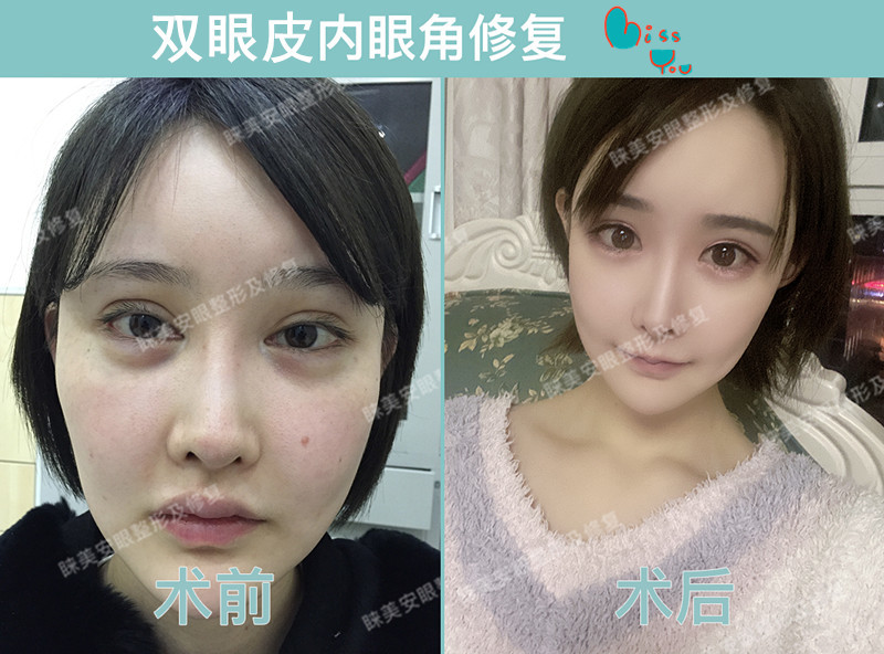 双眼皮恢复期到底需多久?