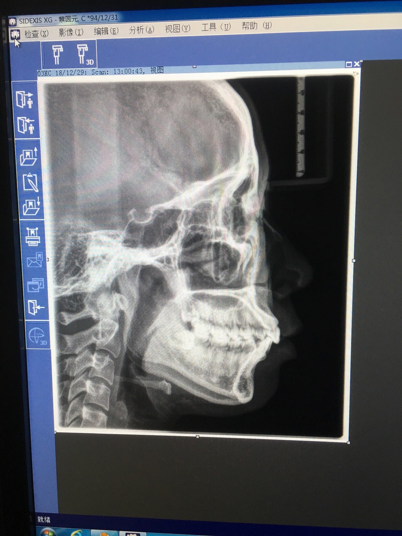 想整牙的第六年,骨性凸正畸能不能矫正嘴凸呐亲爱的羊羊抽下我,拜托