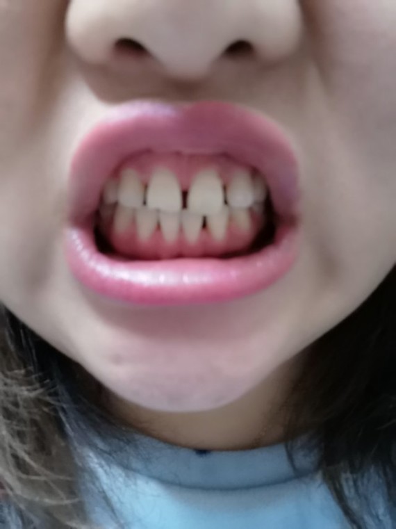 从小牙齿稀疏不整齐有牙缝(;(;`)特别羡慕牙齿整齐洁白