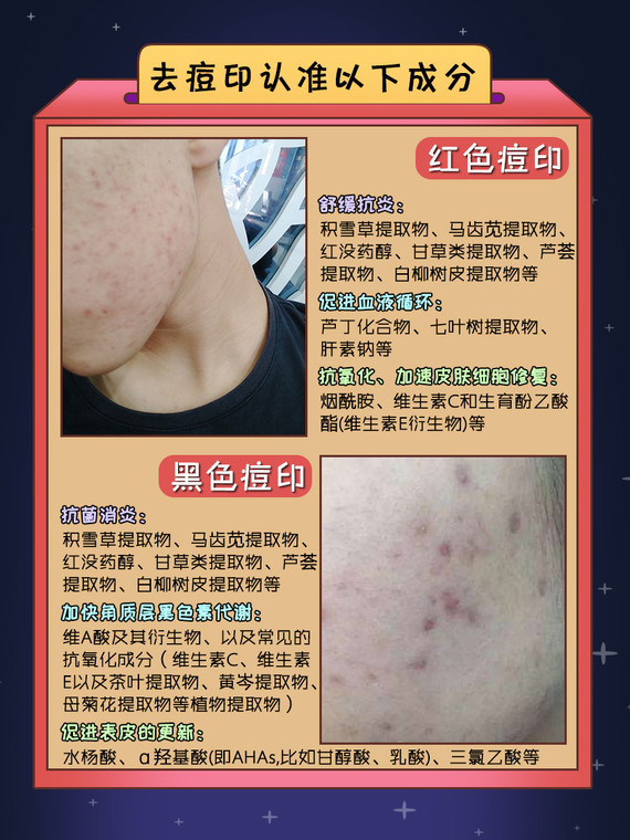 先来认识痘印的类型: 痘印分为红色痘印和褐/黑色痘印 红色痘印 是