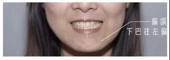 上图中她的牙齿上下中线没有对齐下巴偏向左边,面部不对称.
