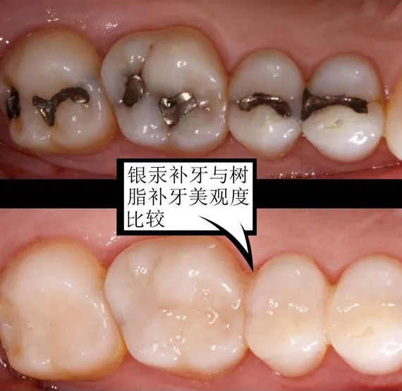 过去用啥补牙?银汞合金优点:在树脂补牙未普及之前