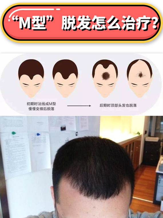 半永久发际线