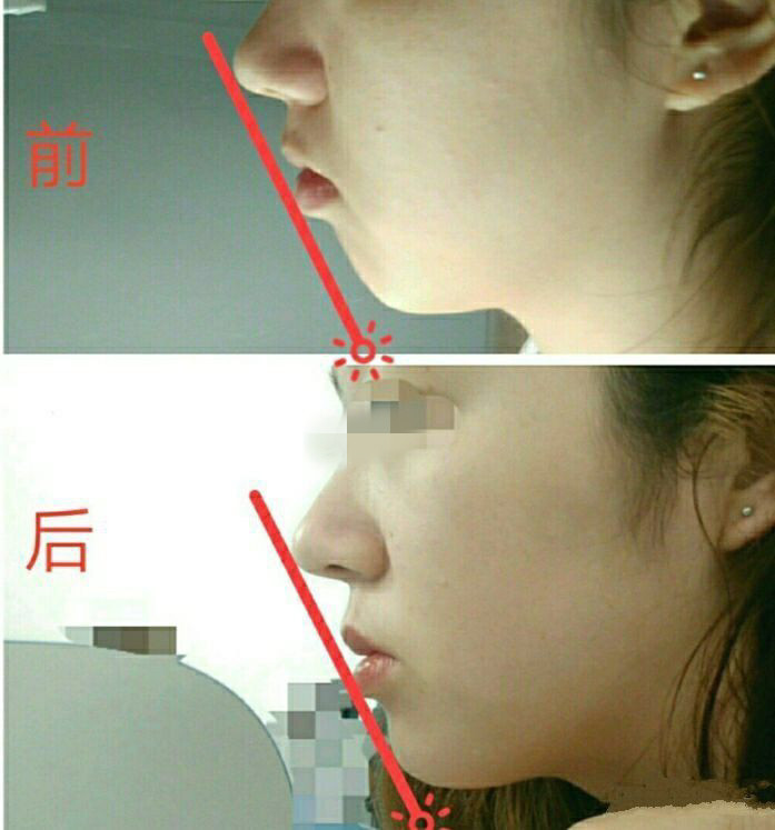2,骨性前凸:由于上颌骨发育过度,或者下颌骨出现后缩现象造成的前突