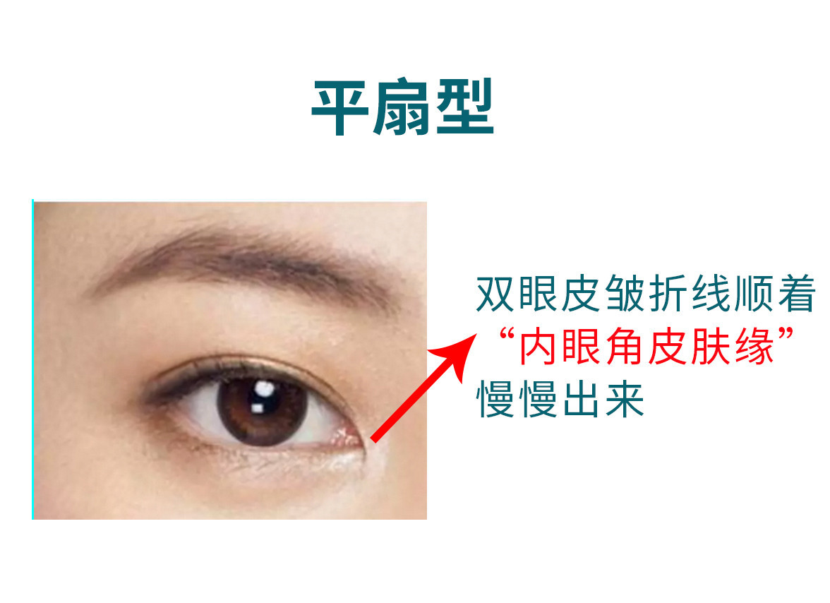 双眼皮形状大致分为4种类型,平行,扇形,新月型,欧式双眼皮.